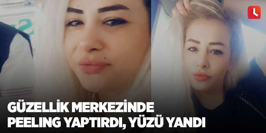 Güzellik merkezinde peeling yaptırdı, yüzü yandı